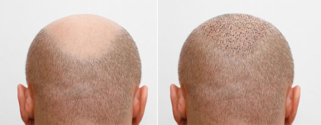 Hair Transplant in jabalpur