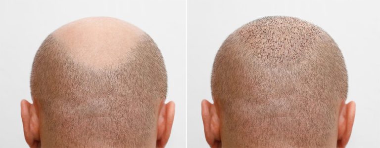 Hair Transplant in jabalpur
