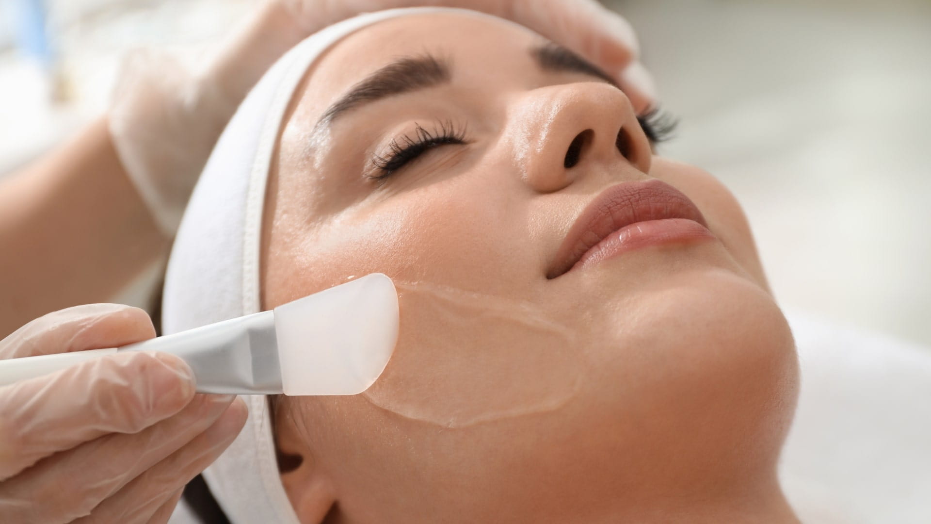 Chemical Peels
