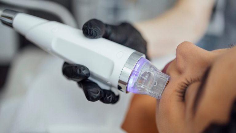 MICRONEEDLING RADIO FREQUENCY