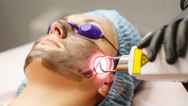 Q-Swith ND-YAG Laser