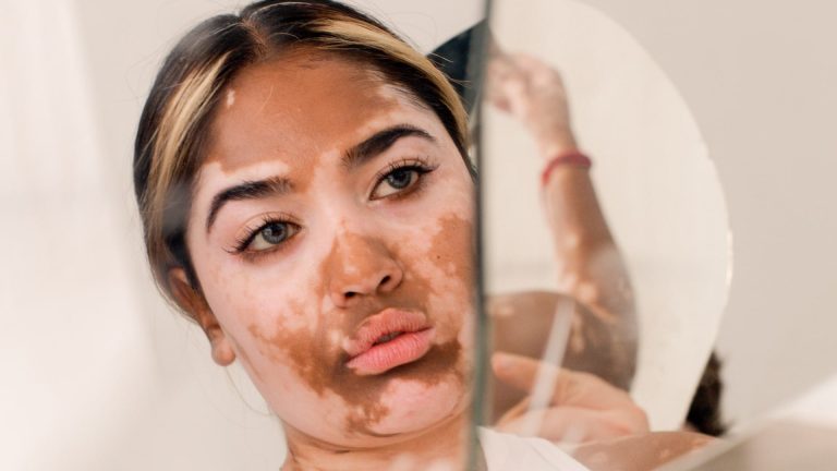 Excimer Laser For Vitiligo